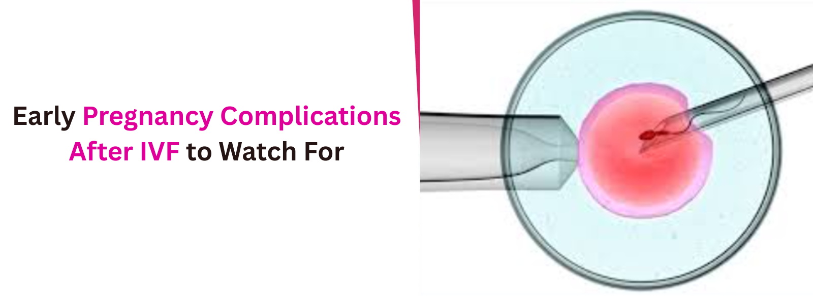 Early Pregnancy Complications After IVF to Watch For