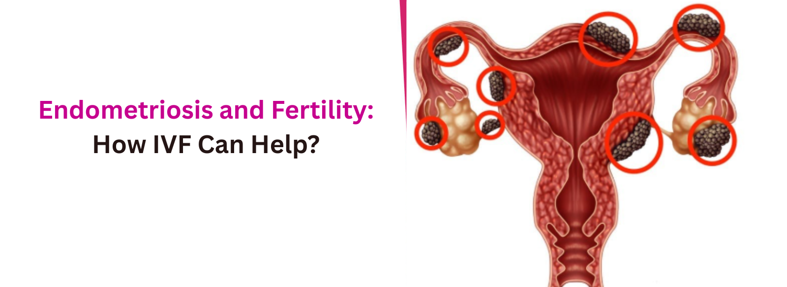 Endometriosis and Fertility: How IVF Can Help?