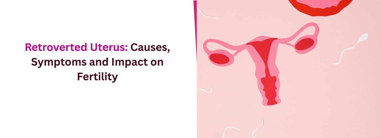 Retroverted Uterus: Causes, Symptoms and Impact on Fertility
