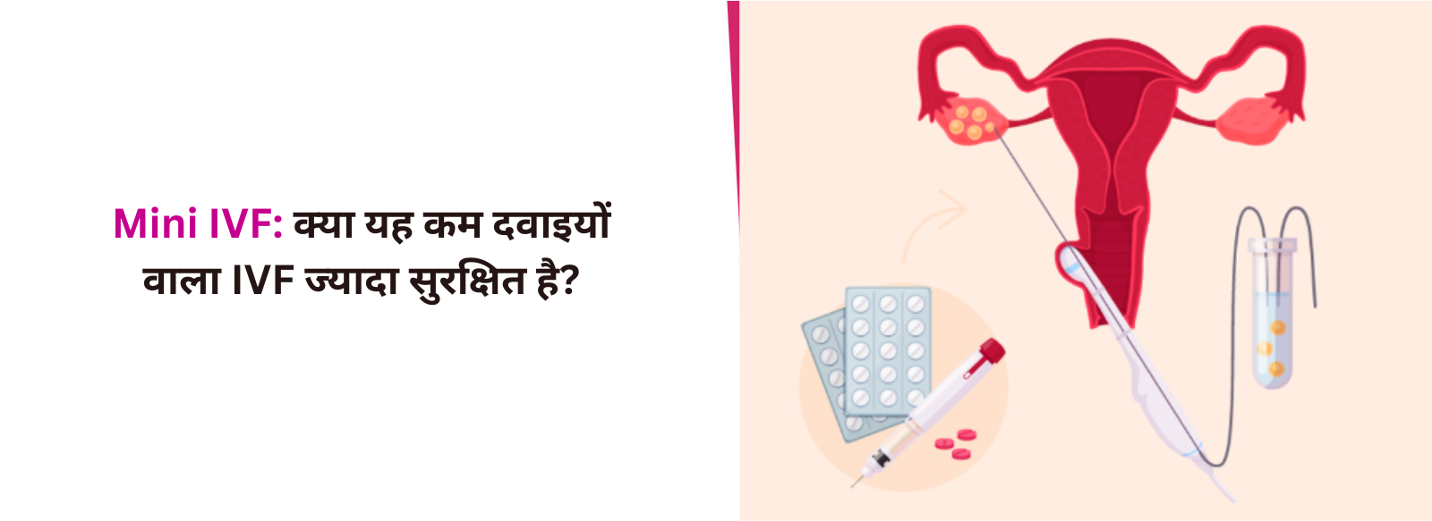 Mini IVF: क्या यह कम दवाइयों वाला IVF ज्यादा सुरक्षित है?