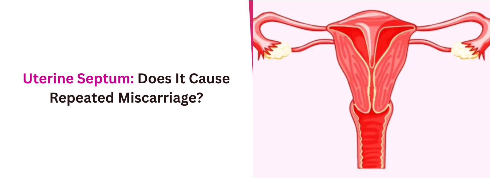 Uterine Septum: Does It Cause Repeated Miscarriage?