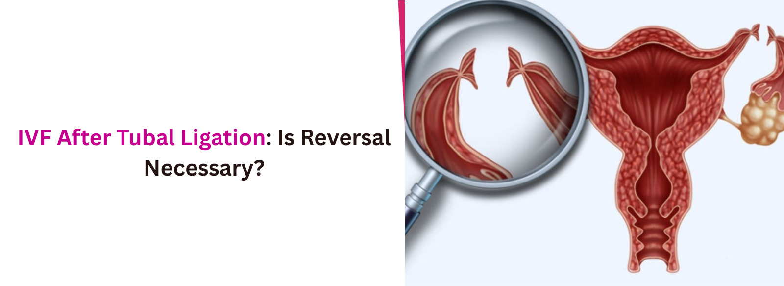 IVF After Tubal Ligation: Is Reversal Necessary?
