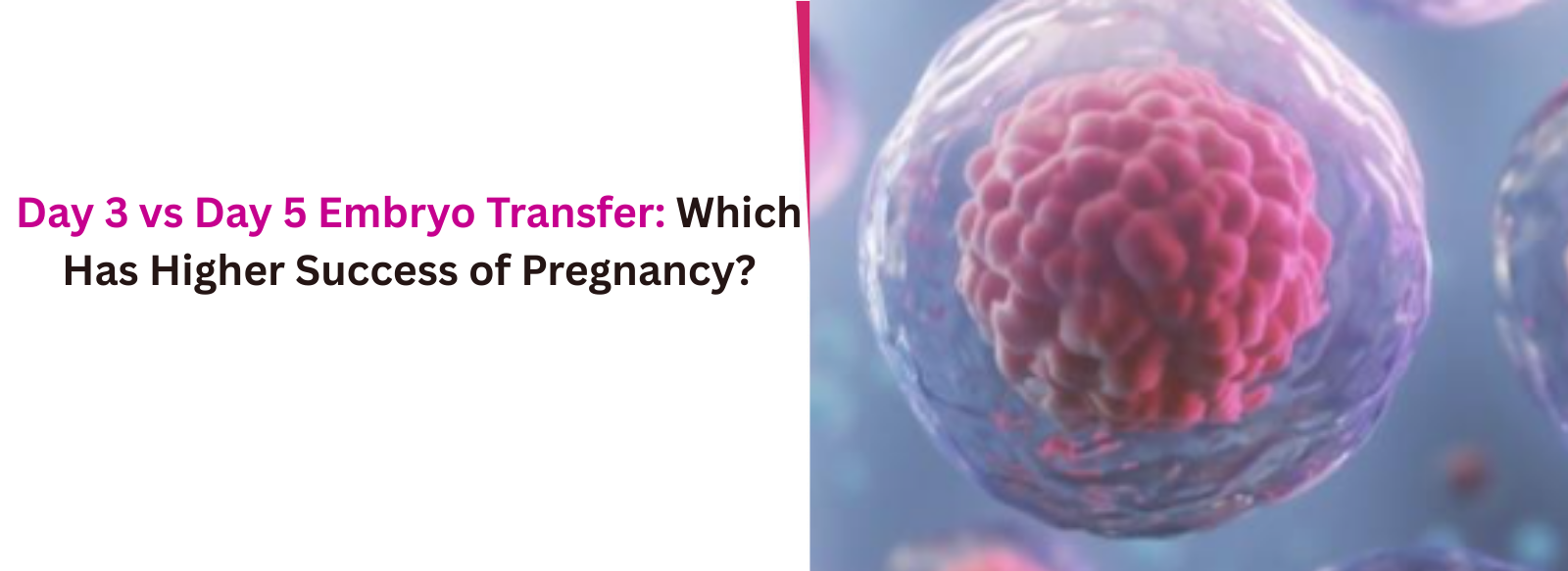 Day 3 vs Day 5 Embryo Transfer: Which Has Higher Success of Pregnancy?