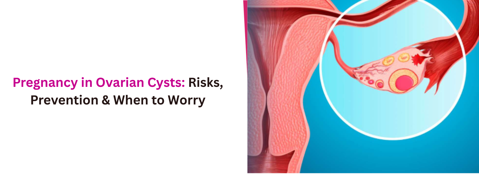 Pregnancy in Ovarian Cysts: Risks, Prevention & When to Worry