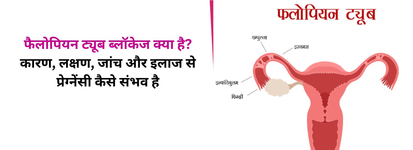 फैलोपियन ट्यूब ब्लॉकेज क्या है? कारण, लक्षण, जांच और इलाज से प्रेग्नेंसी कैसे संभव है