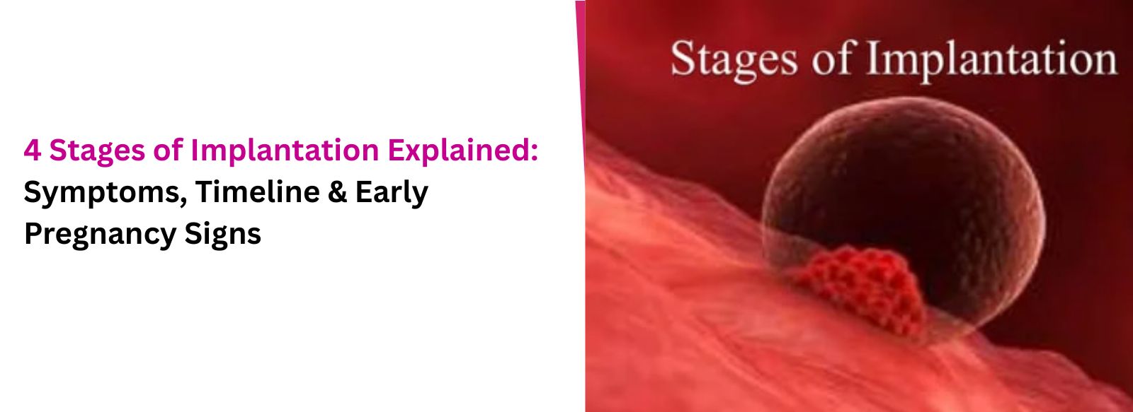 4 Stages of Implantation Explained: Symptoms, Timeline & Early Pregnancy Signs