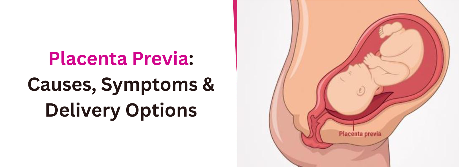 Placenta Previa: Causes, Symptoms & Delivery Options
