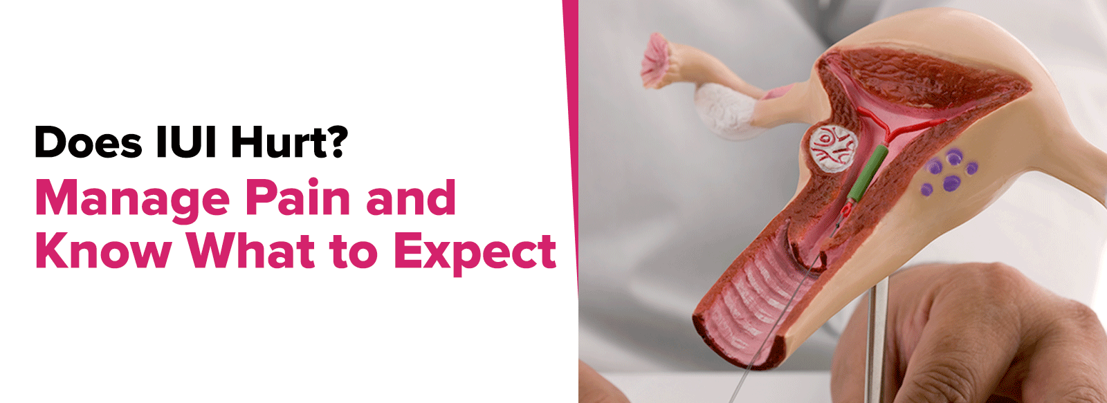 Does IUI Hurt? Manage Pain and Know What to Expect