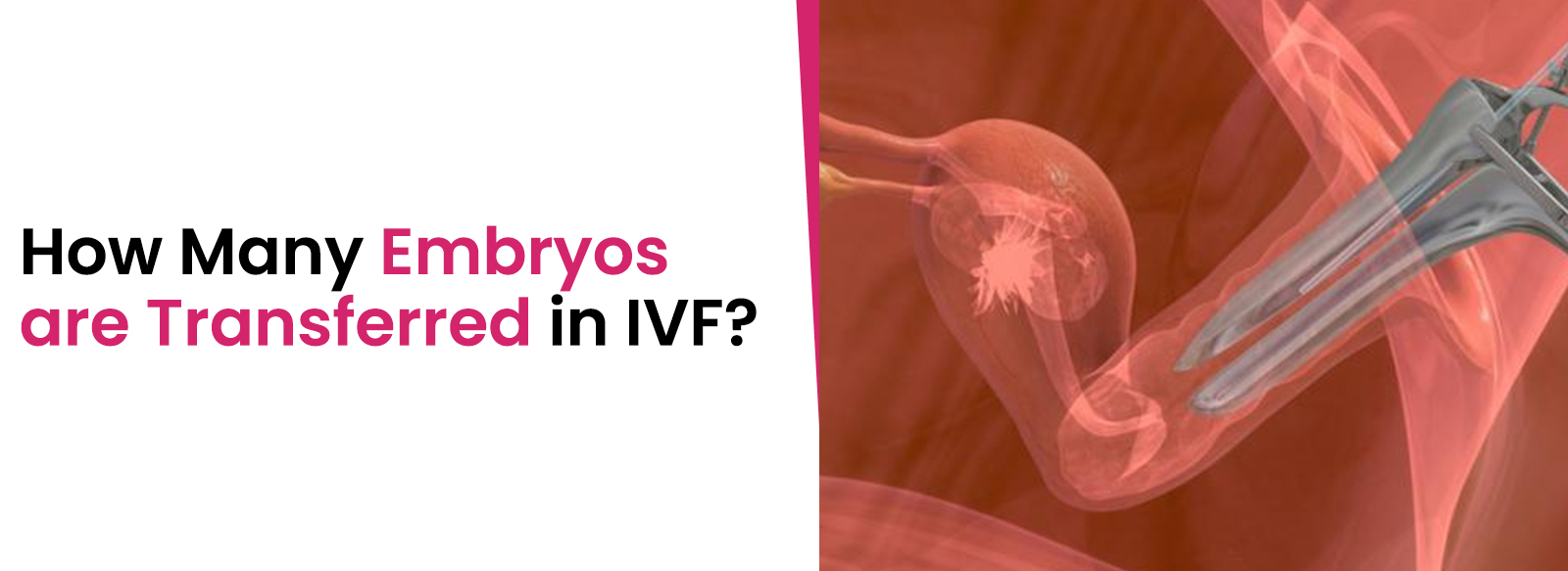 How Many Embryos are Transferred in IVF?