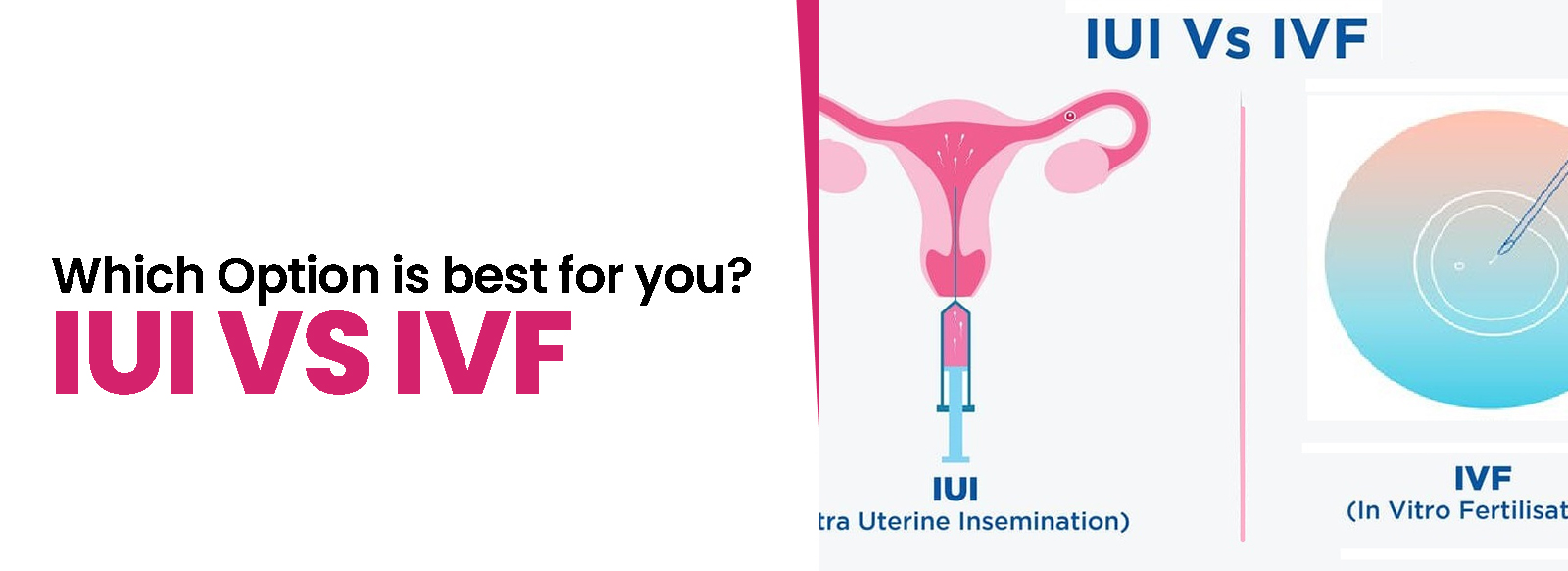 IUI vs IVF: Which Option is Best for You?