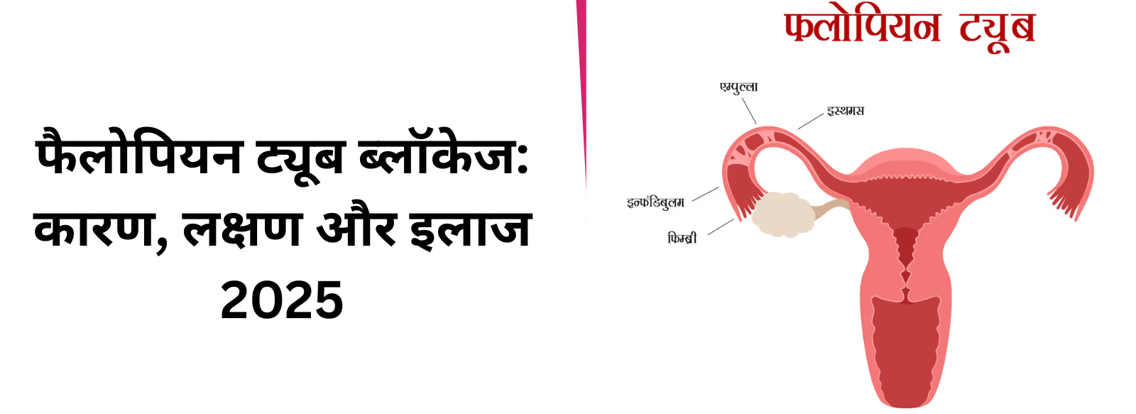 फैलोपियन ट्यूब ब्लॉकेज: कारण, लक्षण, जांच, उपचार और संपूर्ण मार्गदर्शन 2025